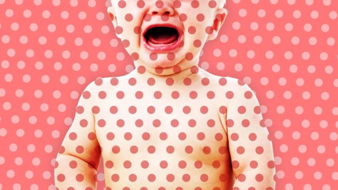 Barefoot Doctor Tells Truth about Measles - A close up of food - 2019 Pacific Northwest measles outbreak