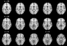 a group of brain images showing different areas of the brain